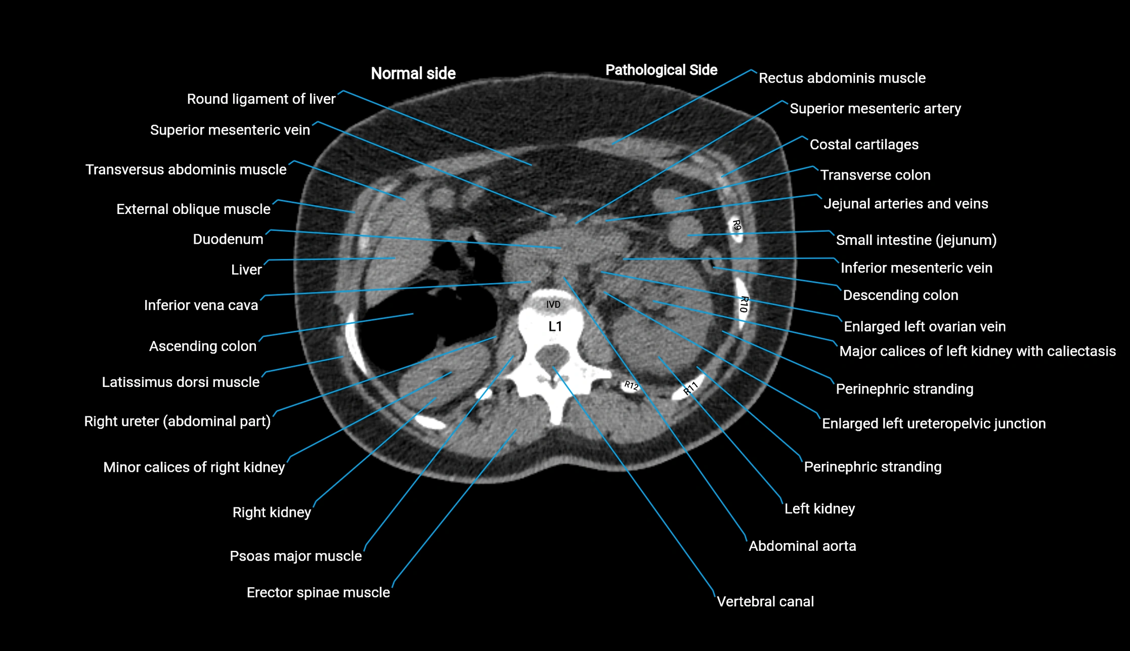 CT KUB axial cross sectional anatomy  radiology image -img-00201-00046.webp